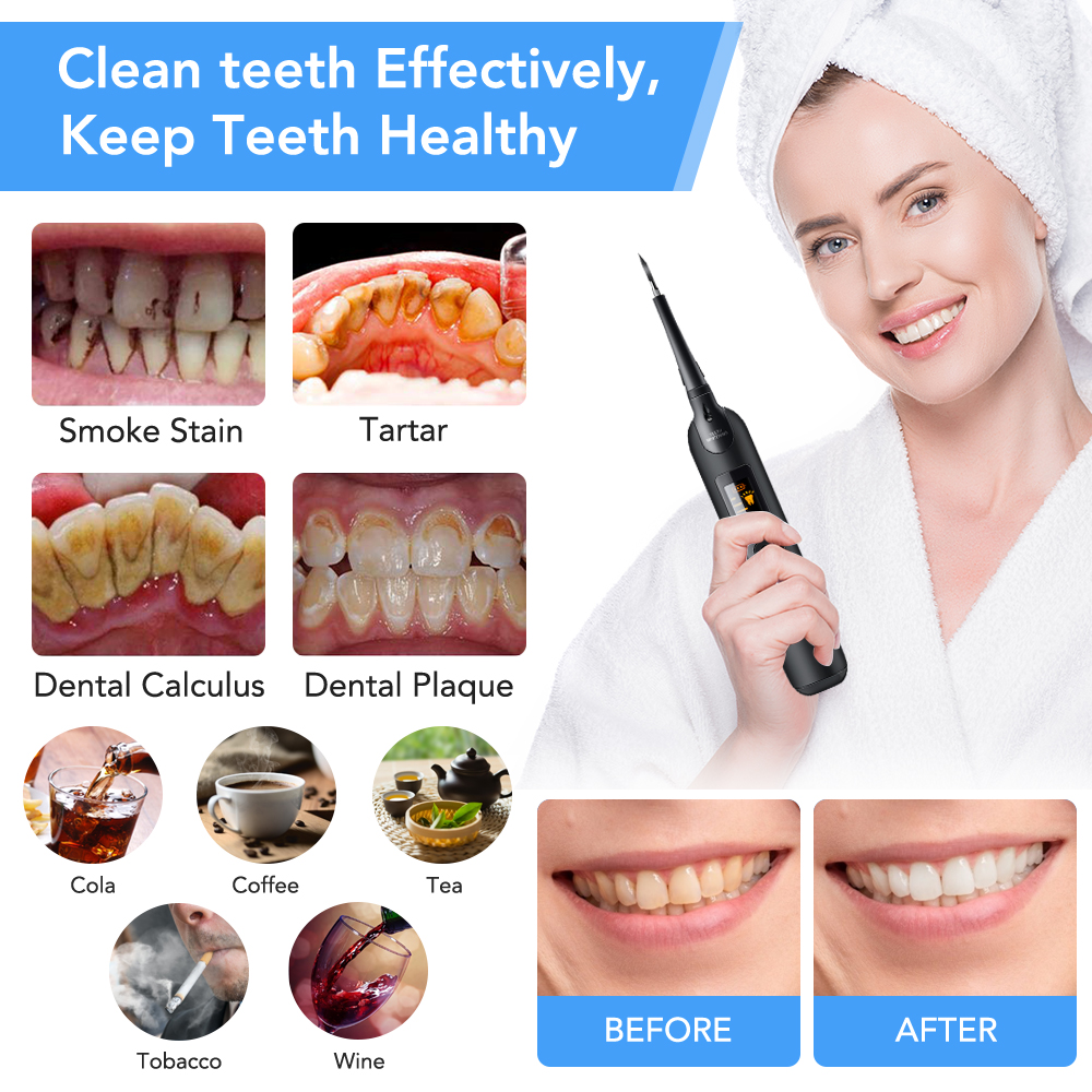 Teeth Tartar Remover Electric  – обзор и цена Teeth Whitening Zoom
