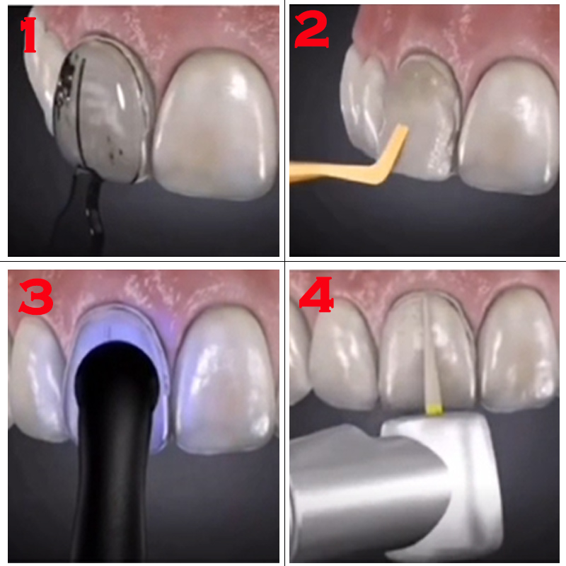 Dental Mold for Composite Resi – обзор и цена Teeth Whitening Zoom
