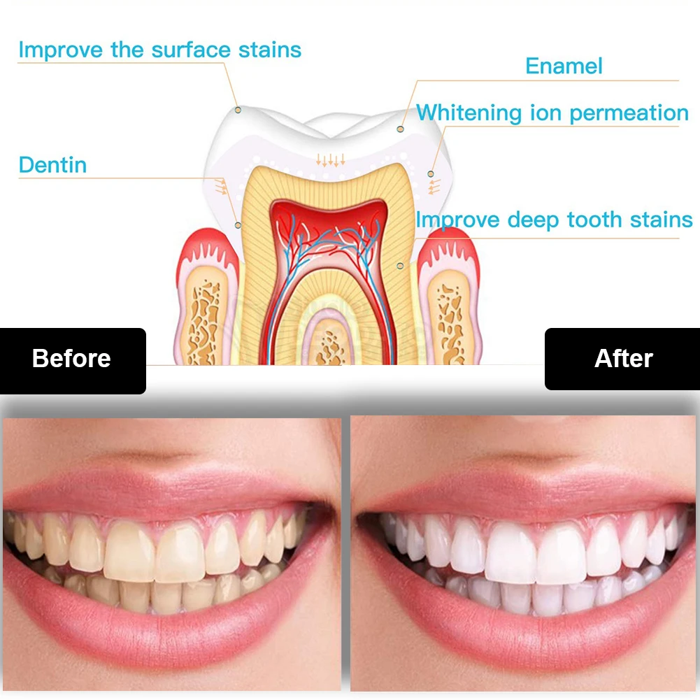 Dental Teeth Whitening Kit Min – обзор и цена Teeth Whitening Zoom
